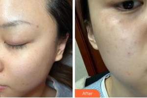 溫州星范醫(yī)學(xué)美容門診部陳乃波整形價(jià)格表附激光祛斑案例展示