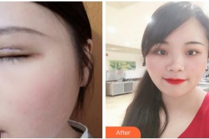 溫州星范醫(yī)學(xué)美容門診部葉信海整形價(jià)格表附切開雙眼皮案例展示