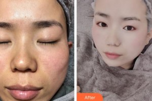 溫州星范醫(yī)學(xué)美容門診部徐慧整形價(jià)格表附激光祛斑案例展示