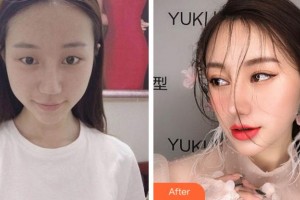 溫州藝星醫(yī)學(xué)美容醫(yī)院黃澤春整形價(jià)格表附眼部綜合案例展示