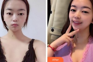 溫州雅美姬整形美容醫(yī)院王公望整形價格表附自體脂肪隆胸案例展示