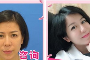 溫州藝星醫(yī)學(xué)美容醫(yī)院湯忠緯整形價格表附埋線提升案例展示