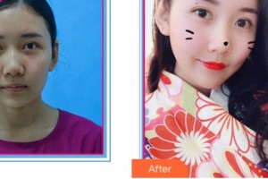 溫州醫(yī)學(xué)院附屬第一醫(yī)院整形外科鄭君達(dá)整形價格表附射頻緊膚案例展示