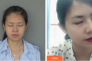 溫州芘麗芙美容醫(yī)院江昌鈞整形價格表附切開雙眼皮案例展示