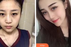 溫州醫(yī)學(xué)院附屬第一醫(yī)院整形外科潘臻文整形價格表附鼻部綜合案例展示