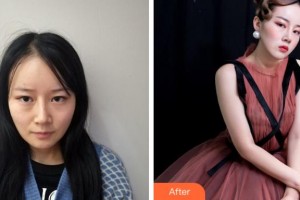 溫州永嘉東方整形外科門診部陳金西整形價格表附鼻部綜合案例展示