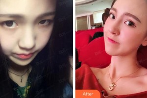 溫州藝星醫(yī)學(xué)美容醫(yī)院楊連華整形價格表附鼻部綜合案例展示