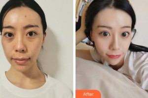 溫州友好醫(yī)院整形美容中心陳瑤整形價格表附埋線提升案例展示