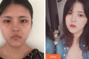 溫州雅美姬整形美容醫(yī)院張東舜整形價格表附埋線提升案例展示