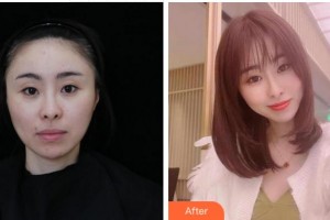 溫州東華醫(yī)院醫(yī)療美容科李營整形價格表附膠原蛋白除皺案例展示