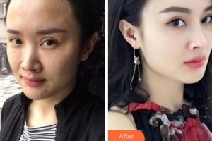 溫州解放軍118醫(yī)院整形科陳世棟整形價格表附熱瑪吉案例展示