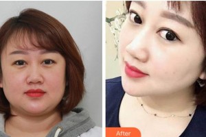 溫州藝美整形美容醫(yī)院金蓉整形價格表附眼部整形案例展示