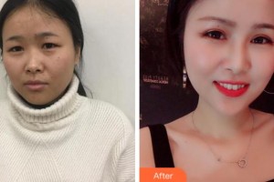 溫州韓美整形美容醫(yī)院周杰群整形價格表附眼部綜合案例展示