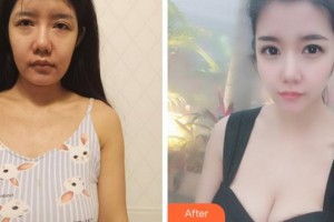 溫州韓美整形美容醫(yī)院邰守權(quán)整形價格表附隆胸案例展示