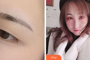 溫州藝星醫(yī)學美容醫(yī)院馬秀芬整形價格表附切開雙眼皮案例展示