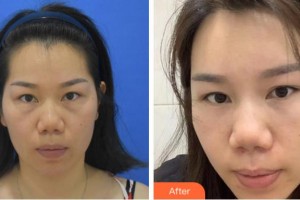 溫州東華醫(yī)院醫(yī)療美容科馬昌樺整形價格表附激光去眼袋案例展示