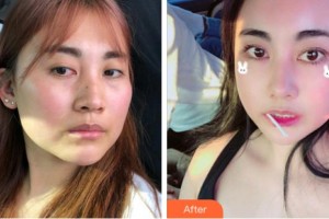 溫州東華醫(yī)院醫(yī)療美容科張鑌整形價格表附眼部綜合案例展示