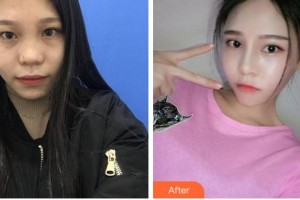 溫州東華醫(yī)院醫(yī)療美容科趙國錄整形價格表附埋線雙眼皮案例展示