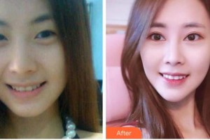 溫州東華醫(yī)院醫(yī)療美容科孫艷華整形價格表附定點雙眼皮案例展示