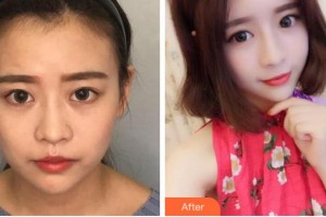 溫州芙萊拉醫(yī)療美容醫(yī)院毛志翔整形價格表附熱瑪吉案例展示