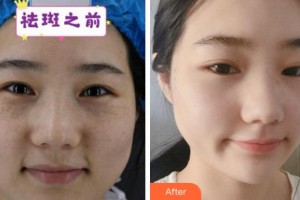 溫州上雅醫(yī)學美容門診部吳慧明整形價格表附激光祛斑案例展示