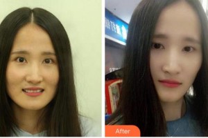 溫州王曉峰口腔醫(yī)院王曉峰整形價格表附牙齒陶瓷矯正案例展示