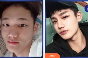 溫州伯思立醫(yī)院醫(yī)療美容科周亞超整形價(jià)格表附切開(kāi)雙眼皮案例展示