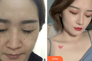 深圳西諾醫(yī)療美容門診部侯艷萍整形價(jià)格表附激光祛斑案例展示