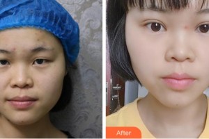 溫州伯思立醫(yī)院醫(yī)療美容科周薇整形價(jià)格表附切開(kāi)雙眼皮案例展示