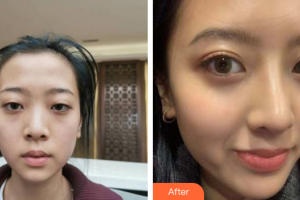 深圳晨曦醫(yī)療美容醫(yī)院吉梅斯整形價(jià)格表附半肋鼻部手術(shù)案例展示