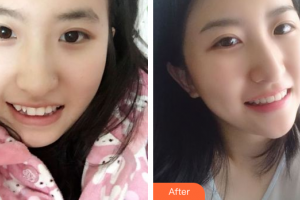 深圳博美醫(yī)療美容門診部高凱整形價(jià)格表附隱適美矯正案例展示