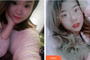 溫州醫(yī)科大學(xué)附屬口腔學(xué)院黃盛斌整形價(jià)格表附牙齒隱形矯正案例展示