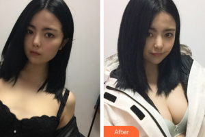 深圳易容顏醫(yī)療美容門診部劉金虎整形價(jià)格表附自體脂肪隆胸案例展示