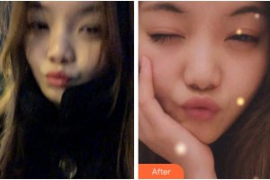 溫州醫(yī)科大學(xué)附屬口腔學(xué)院何奎芳整形價(jià)格表附牙齒隱形矯正案例展示