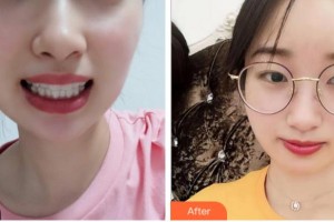 溫州醫(yī)科大學(xué)附屬口腔學(xué)院倪振宇整形價(jià)格表附牙齒隱形矯正案例展示