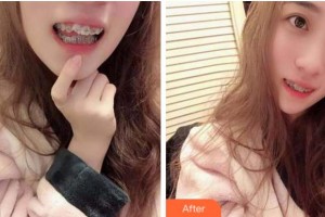 溫州醫(yī)科大學(xué)附屬口腔學(xué)院鄧振南整形價(jià)格表附金屬托槽矯正案例展示