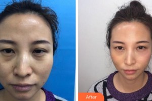 溫州明樂眼科醫(yī)院魏桂英整形價格表附眼部綜合案例展示