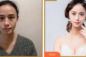 溫州醫(yī)科大學(xué)附屬眼視光醫(yī)院吳文燦整形價格表附眼部綜合案例展示