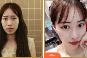 溫州醫(yī)科大學(xué)附屬眼視光醫(yī)院葉宇峰整形價格表附眼部綜合案例展示