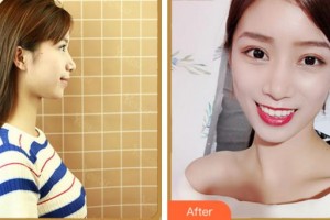 溫州醫(yī)科大學(xué)附屬眼視光醫(yī)院溫淑梅整形價格表附眼鼻多項案例展示