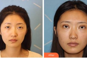 溫州醫(yī)科大學(xué)附屬眼視光醫(yī)院戴琦整形價格表附切開雙眼皮案例展示