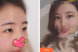 溫州醫(yī)科大學(xué)附屬眼視光醫(yī)院陳亦棋整形價格表附切開雙眼皮案例展示