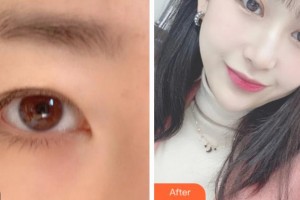 溫州醫(yī)科大學(xué)附屬眼視光醫(yī)院聶莉整形價格表附眼部綜合案例展示