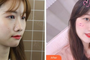 溫州醫(yī)科大學(xué)附屬眼視光醫(yī)院常平駿整形價(jià)格表附眼部整形案例展示