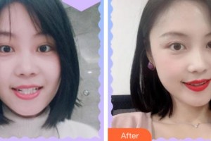 溫州拜博口腔醫(yī)院唐甸飛整形價(jià)格表附金屬托槽矯正案例展示