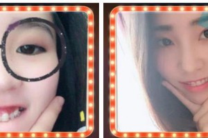 溫州醫(yī)科大學(xué)附屬眼視光醫(yī)院傅亞娜整形價(jià)格表附牙齒陶瓷矯正案例展示