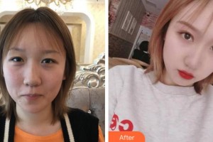 溫州醫(yī)科大學(xué)附屬眼視光醫(yī)院黃錦海整形價(jià)格表附切開雙眼皮案例展示