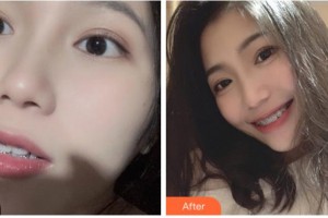 溫州華君美口腔門診部王光耀整形價(jià)格表附自鎖托槽矯正案例展示