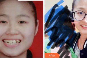 溫州藍(lán)芽口腔門診部趙微整形價(jià)格表附金屬托槽矯正案例展示