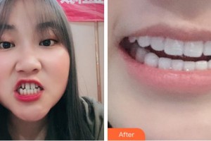 溫州牙博士口腔門診部劉名燕整形價(jià)格表附牙貼面案例展示